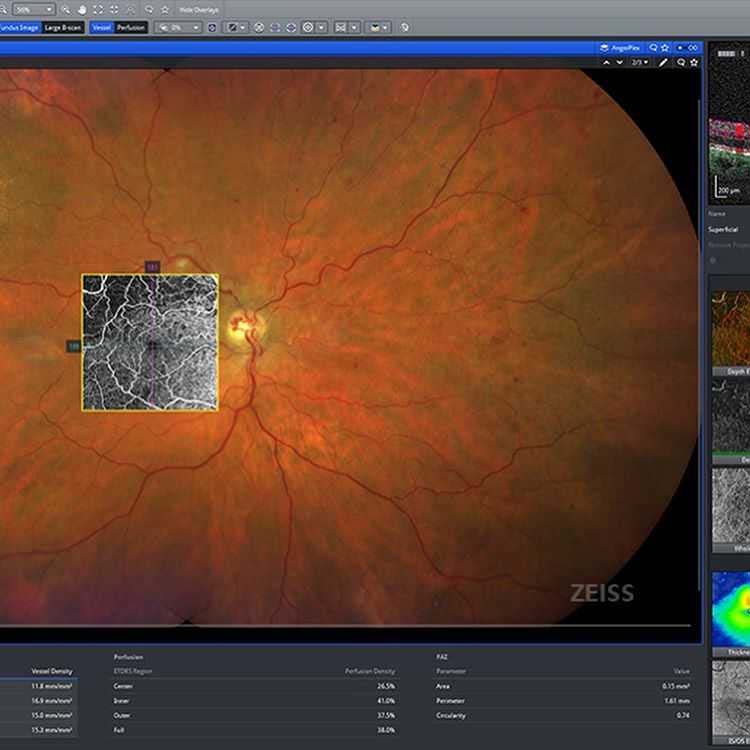 Zeiss Clarus 500 Ultra Imaging